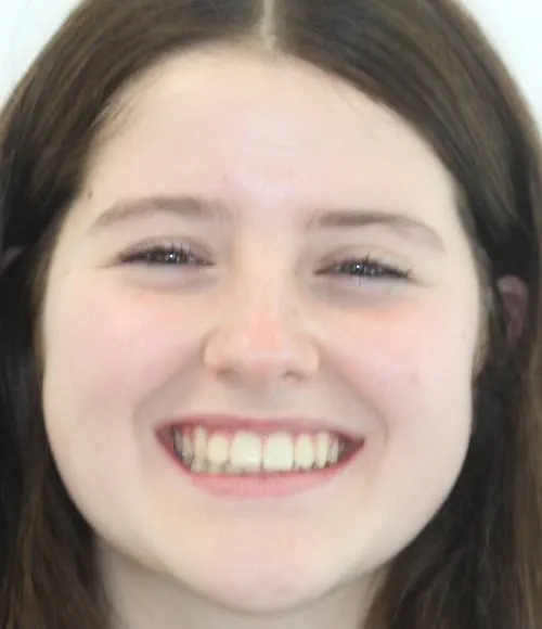 After treatment, Lexi's teeth are straight and aligned