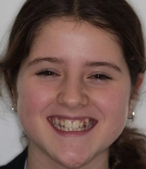 Lexi's teeth sit at different heights in the gum and are not aligned