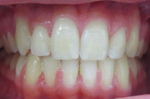 Clean and straight teeth that look perfectly aligned with each other