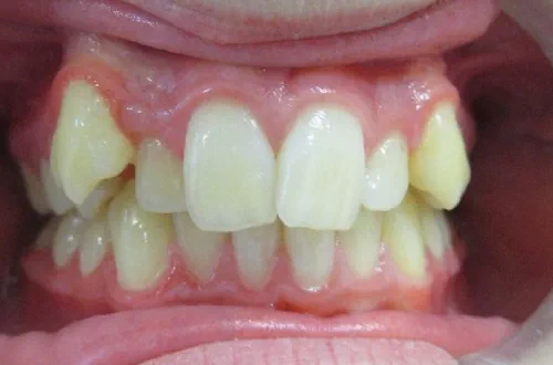 bared teeth with teeth sitting at different heights in the gums with front teeth not straight and slightly overlapping
