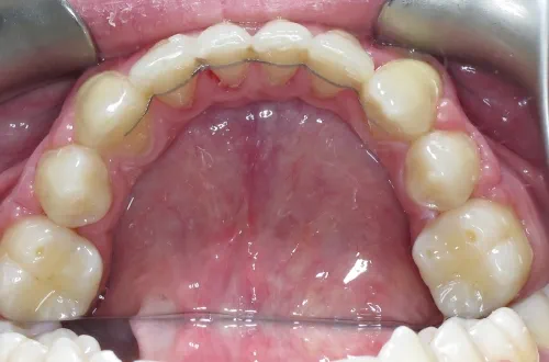 Top arch of teeth seen from below showing all teeth correctly aligned and a silver band (fixed retainer) behind the six front teeth