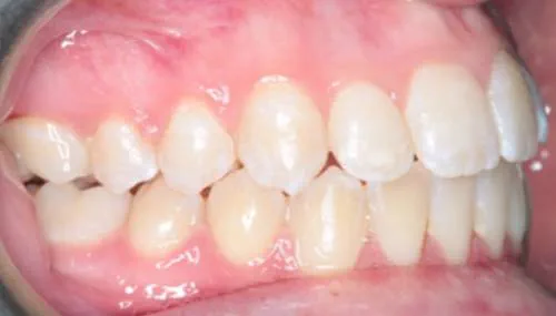 After treatment, the patient's teeth are straight and aligned