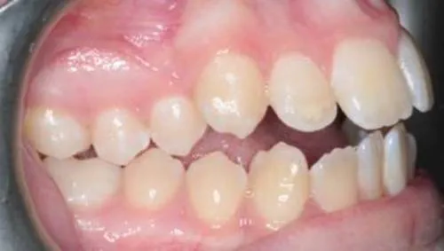 The patient's teeth sit at different heights in the gum and are not aligned