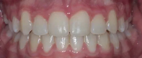 After teeth straightening, the patient's teeth are perfectly aligned