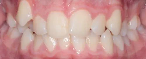 Before treatment, The patient's teeth sit at different heights and don't meet in the bite