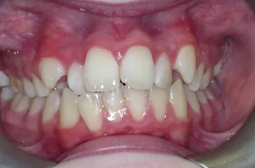 parted lips showing very crooked and misaligned teeth which sit at different heights in the gums