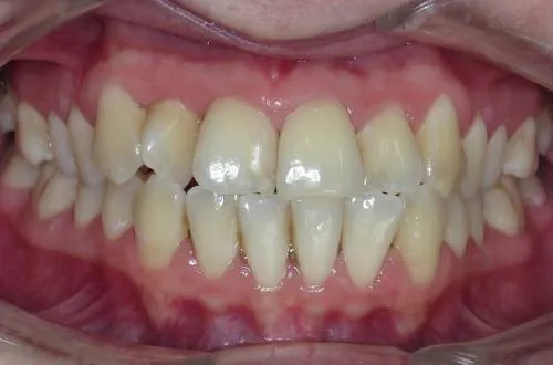 Parted lips showing teeth that overlap and do not sit straight in the gums